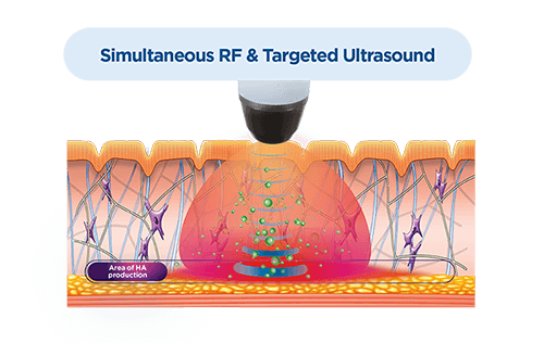 Exion Ultraosund